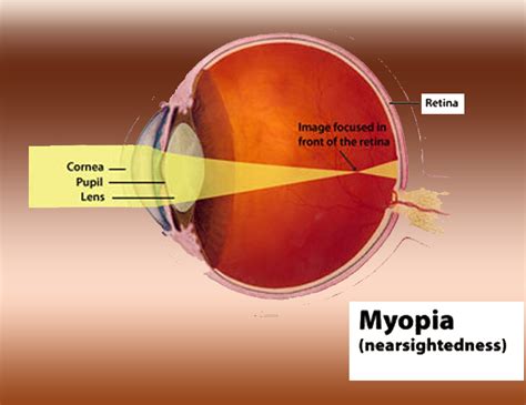 myopia vs hyperopia eyes advisor