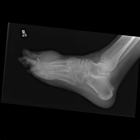 post gad gout foot