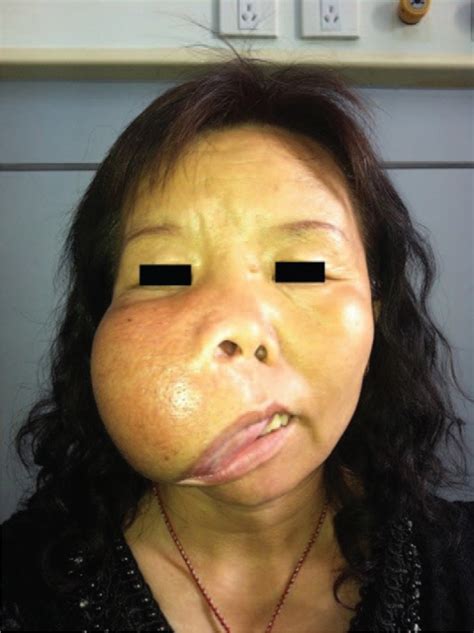 surgical correction of residual facial deformity following