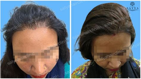 fut hair transplant  grafts satya hair transplant clinic