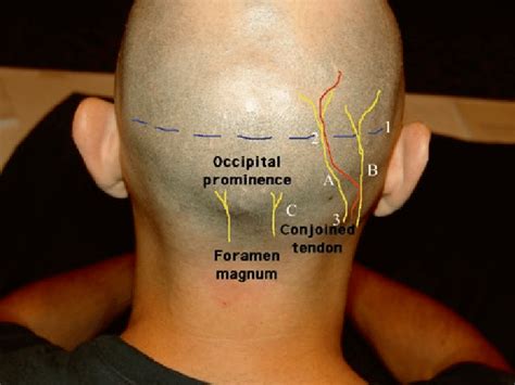 surface anatomy   occipital nerves  greater occipital nerve