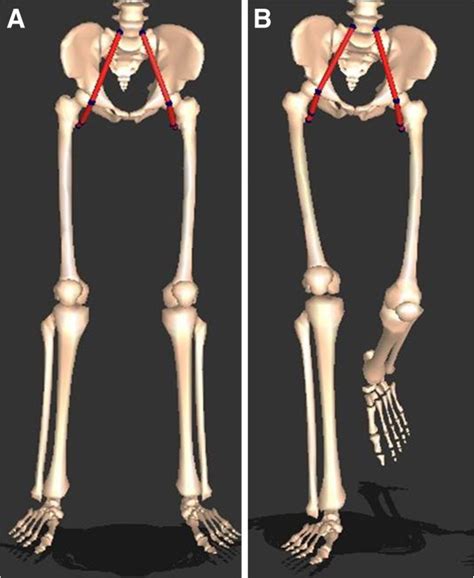 Hamstring And Psoas Length Of Crouch Gait In Cerebral Palsy A