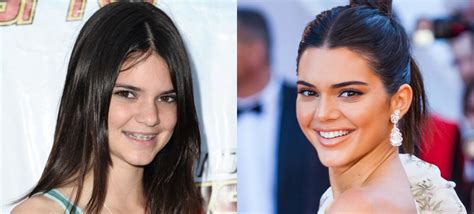 Celebrities With Braces Before And After Celebs Who Had Braces