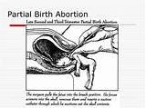 Abortion Birth Partial sketch template