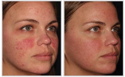 The Huge Benefits Of Halo Laser Treatment Star Plastic Surgery Star