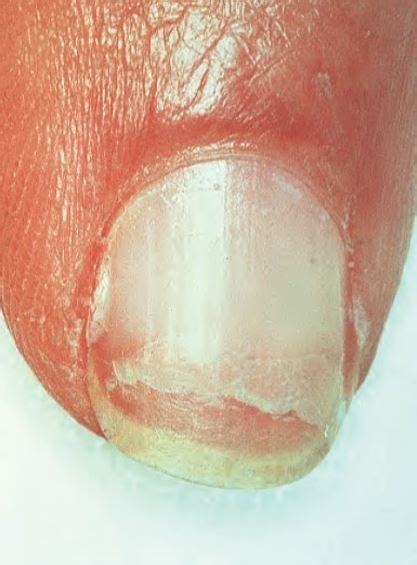 tirnaklarin cabuk kirilmasi nail fragility syndrome brittle nail syndrome
