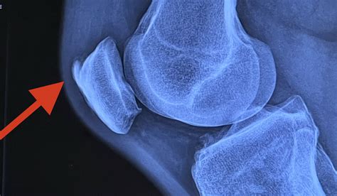 dealt   knee cap bone spur training trainerroad