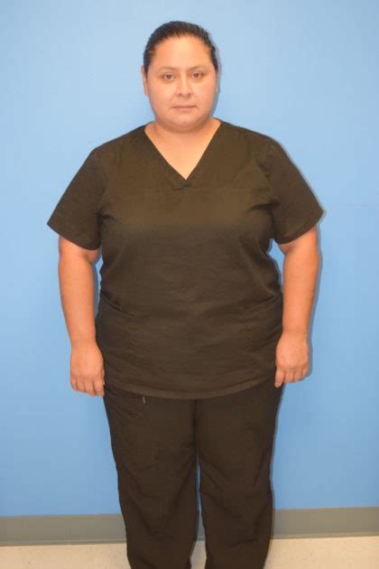Patient 548 Gastric Sleeve Before And After Photos Houston Plastic