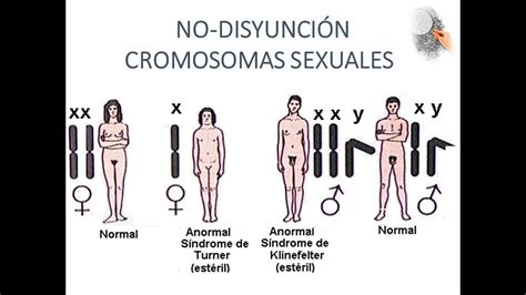 Cromosomas Sexuales Y Síndromes Relacionados X0 Xxy Xyy Youtube