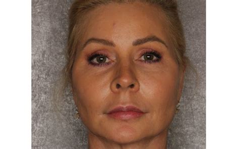 facelift neck lift  azul cosmetic surgery  medical spa  fort