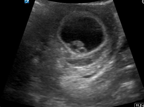 intrauterine pregnancy critical care sonography