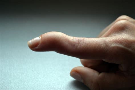 What Is Mallet Finger And How Can I Treat It Maryland Orthopedic
