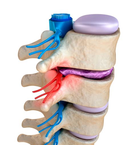 pinched nerve symptoms treatments mn spine institute