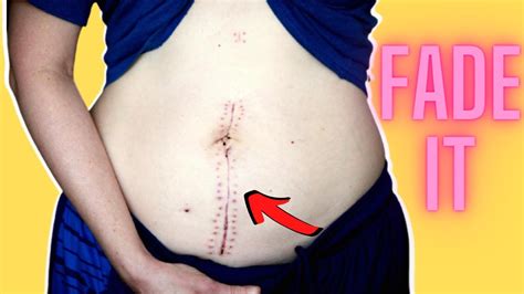 How To Get Rid Of C Section Scar Fast At Home Youtube