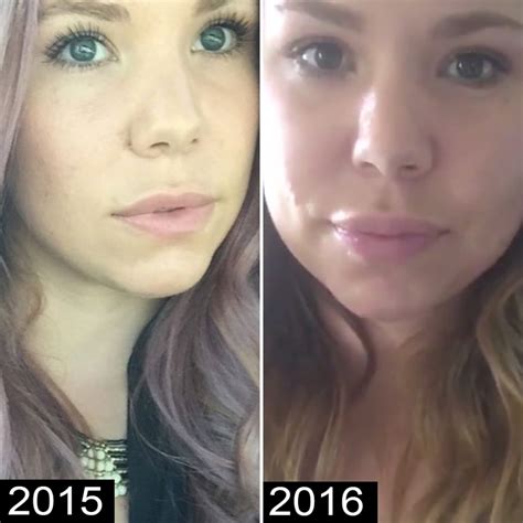 kailyn lowry s plastic surgery transformation before and after pics