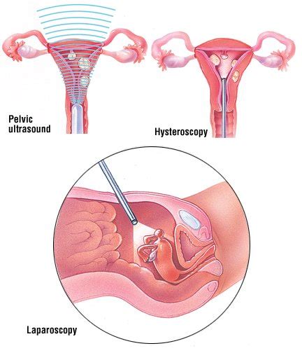 Fibroids Guide Causes Symptoms And Treatment Options