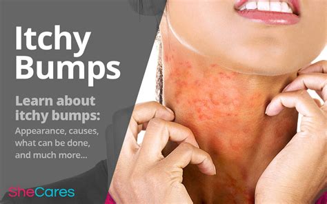 itchy bumps shecares