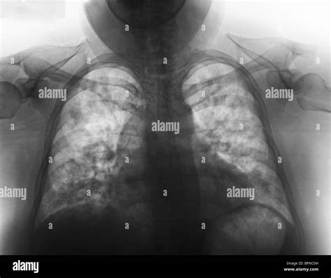 abnormal chest  ray showing pneumonia    year  female  influenza stock photo alamy