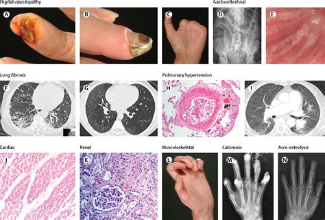 systemic sclerosis  lancet