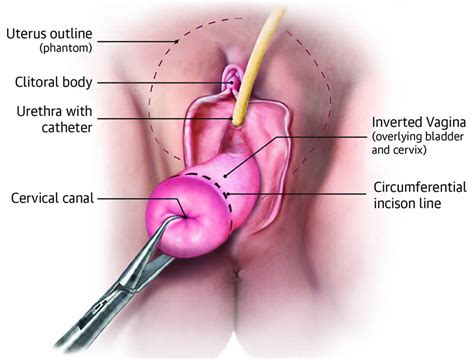 vaginal hysterectomy indications complications steps