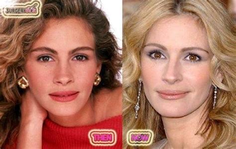 Plastic Surgery Before And After Julia Roberts’ Plastic