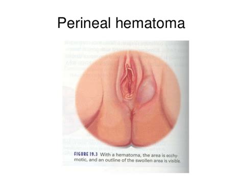 Vulva Hematoma Images