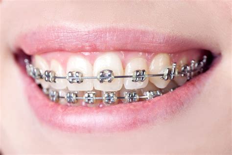 traditional dental braces  invisalign aligners consumer guide