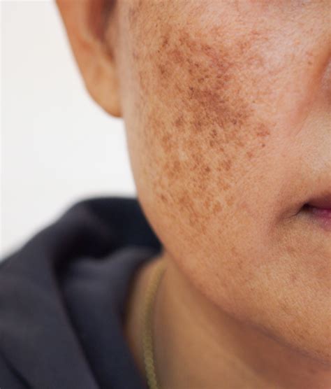 melasma treatments greenville south carolina alma rose