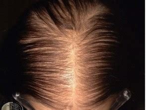 female pattern hair loss dermnet nz