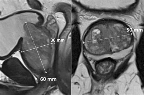 The Radiology Assistant Prostate Cancer Pi Rads V2