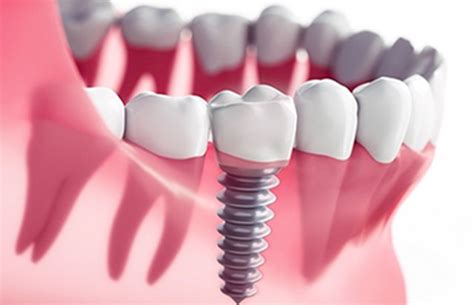 dental implants   procedure  replaces tooth roots  metal