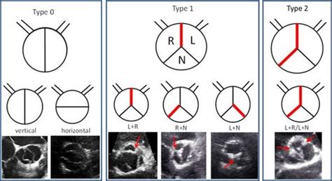Sex Differences In Phenotypes Of Bicuspid Aortic Valve And Aortopathy