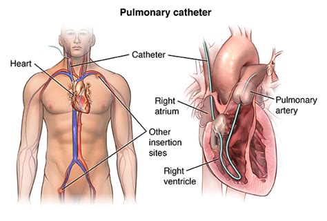 right heart catheterization health encyclopedia university of