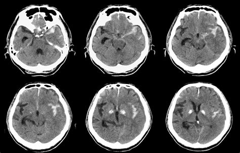 deep learning algorithms identify ct scan abnormalities  head trauma