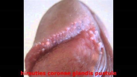 get rid of penile papules fast youtube