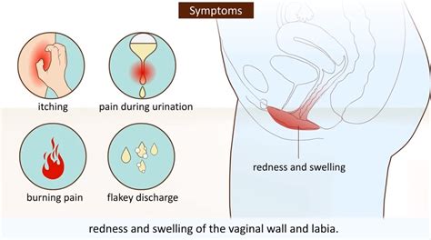 vaginal itching 12 causes and cures of it