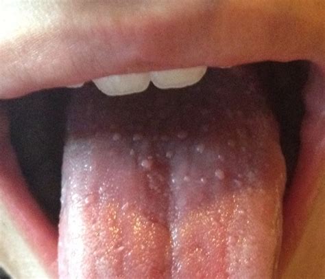 bumps  tongue symptoms  treatment pictures diseases pictures