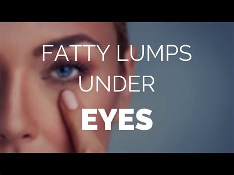 fatty lumps  eyes    treat themfast youtube