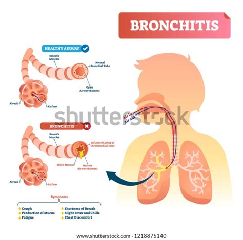 Bronchitis Vector Illustration Lung Disease Diagnosis Stock Vector