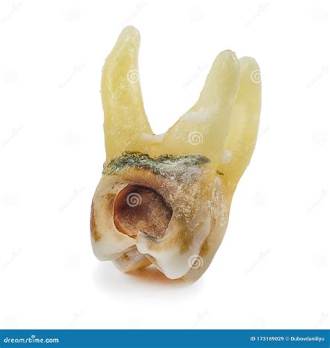affected  caries destroyed   large cavity removed human tooth  large roots chewing