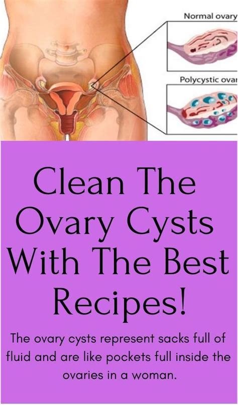 Clean The Ovary Cysts With The Best Recipes Cyst On Ovary Ovaries