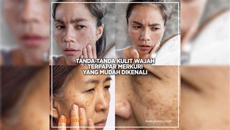 menghilangkan merkuri  wajah  kembali sehat times indonesia
