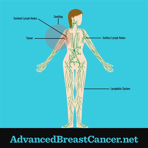 lymphedema  metastatic breast cancer