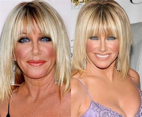 50 Best Images About Celebrity Plastic Surgery Gossip On