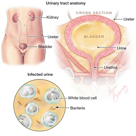 Urinary Tract Infection Infectious Diseases Jama