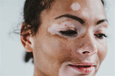 vitiligo  treated