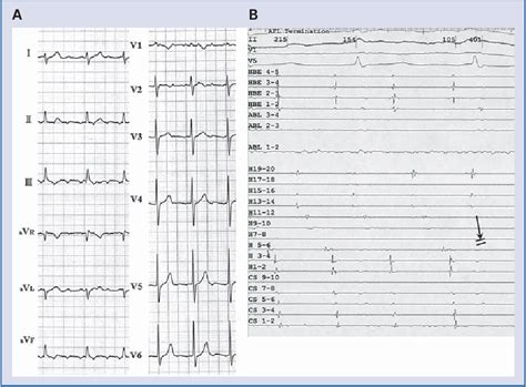 Figure 1 From Typical Atrial Flutter With Atypical Flutter Wave