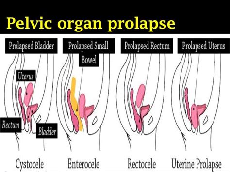 Mesh In Pelvic Organ Prolapse