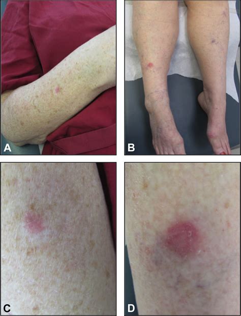 polarized light dermoscopy  aid   diagnosis   pink lesions   amelanotic melanoma