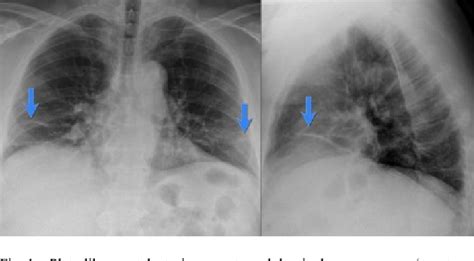 figure   basilar atelectasis   true predictor  acute